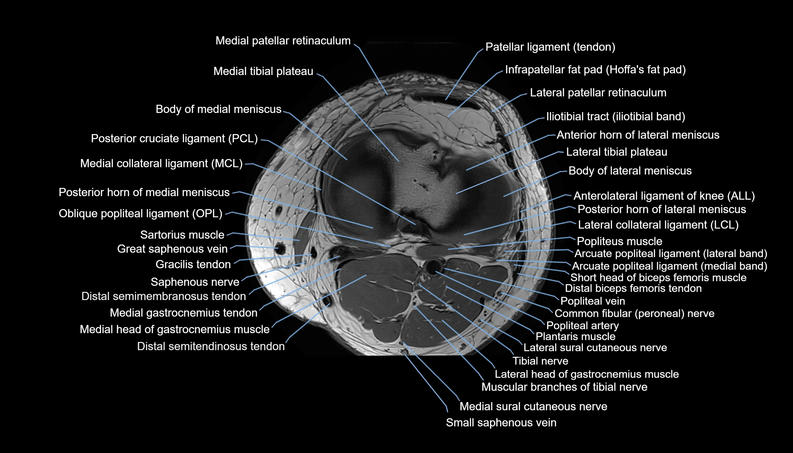 MRI knee  axial cross sectional anatomy 3T radiology  image-img-00001-00031.webp